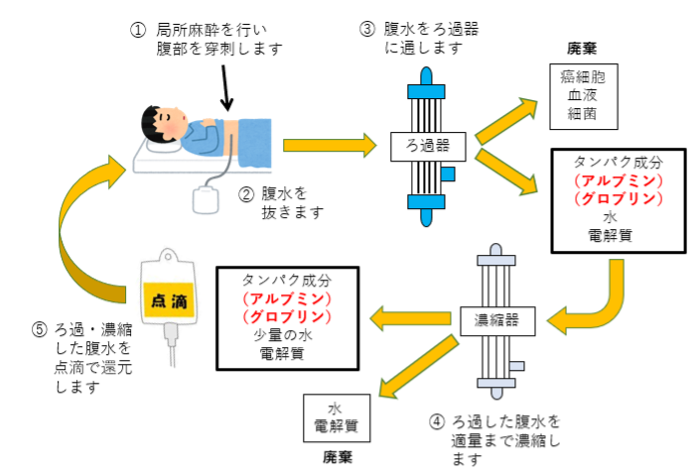 CART（腹水ろ過濃縮再静注法）図